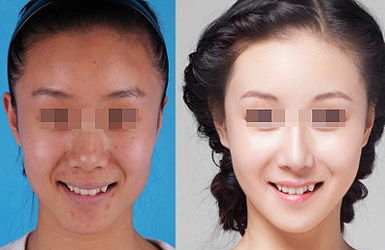 熱拉提的治療效果好不好？多久起效？